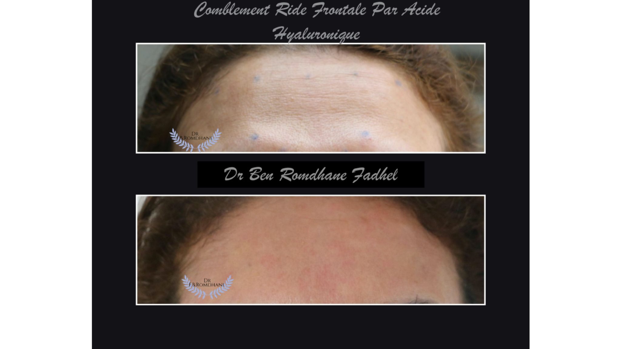 frontoplastie-docteur-ben-romdhane