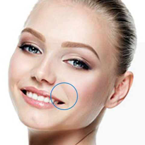 Sillons Nasogéniens