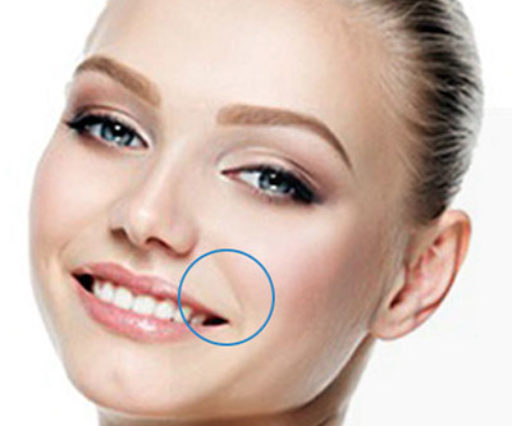 Sillons Nasogéniens