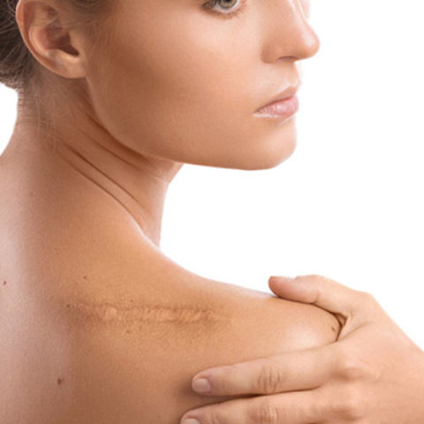 Traitement des cicatrices