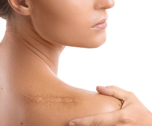 Traitement des cicatrices