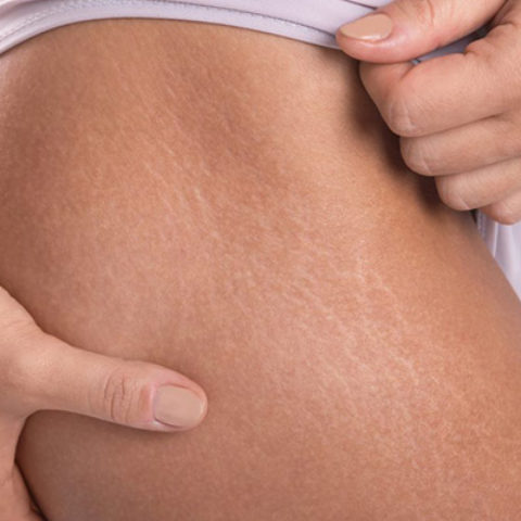 Traitement des vergetures