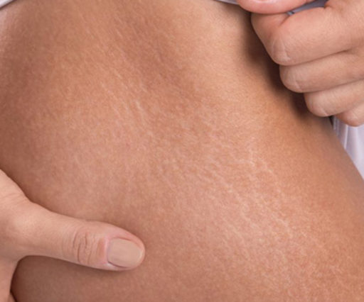 Traitement des vergetures