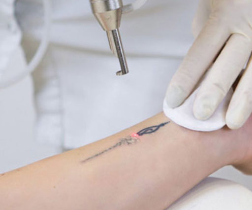 Détatouage laser